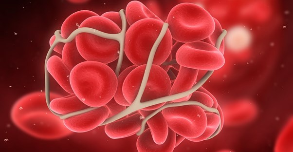 a visual representation of deep vein thrombosis