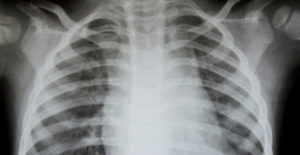an xray looking for signs of copd in the chest cavity