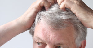a man scratches his scalp psoriasis