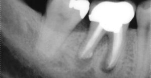 an xray of a tooth to show possible signs of tooth decay